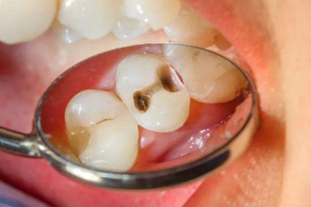 Babi Lancar medium pemayaan caries majeng kanggo deteksi untu